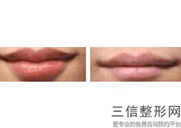 唇腭裂能修复好吗,唇腭裂能修复吗