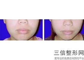 唇腭裂能修复好吗,唇腭裂能修复吗
