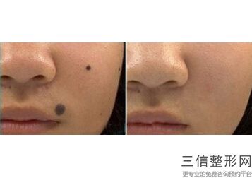 瓷娃娃有什么功效，白瓷娃娃对皮肤有影响吗