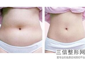 打肉毒素可以瘦小腿吗，打肉毒素瘦小腿有效果吗
