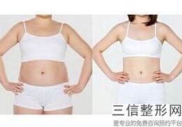大腿吸脂后体重会减轻吗，吸脂瘦腿会不会反弹