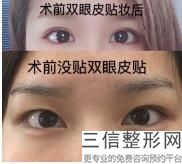 丹凤眼埋线双眼皮图片,丹凤眼适不适合割双眼皮