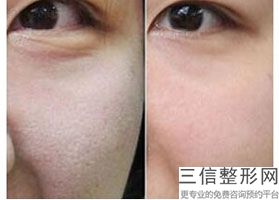 电波拉皮好还是手术拉皮效果好，电波拉皮效果好吗-过时了吗_1