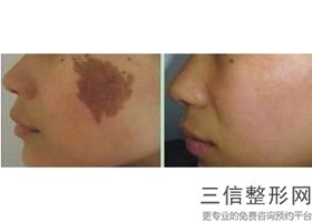 电波拉皮好还是手术拉皮效果好，电波拉皮效果好吗-过时了吗_1