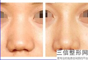 东莞哪家医院做鼻综合好，哪家整形医院做鼻子好