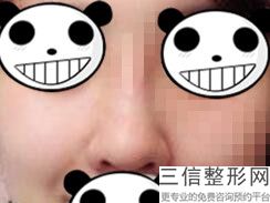 东莞哪家医院做鼻综合好，哪家整形医院做鼻子好