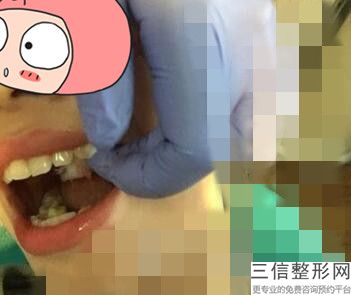 二氧化锆全瓷牙多少钱一颗价格表2020，二氧化锆全瓷牙齿价格