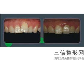 二氧化锆全瓷牙多少钱一颗价格表2020，二氧化锆全瓷牙齿价格