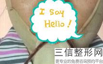 丰唇好不好，用什么丰唇效果好