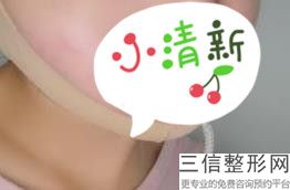 丰唇好不好，用什么丰唇效果好