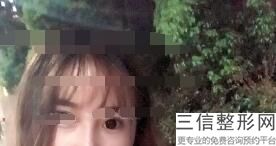 佛山割双眼皮好的医院推荐,佛山割双眼皮哪里好(佛山正规的可以割双眼皮的医院)