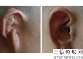 附耳切除有季节限制吗,附耳切除手术较好年龄