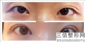 割双眼皮开眼角要多少钱，在割双眼皮开眼角多少钱