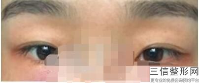 割双眼皮手术效果，割双眼皮后的效果怎么样图片大全