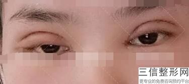 割完双眼皮对视力有影响吗，请问割双眼皮手术会影响到视力吗-