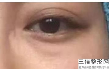 割完双眼皮可以吃鱼-，割双眼皮之后能吃鱼吗