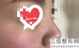 给鼻子注射玻尿酸隆鼻能保持多久，玻尿酸隆鼻多久注射一次