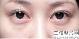 光子嫩肤去黑眼圈真实经历，光子嫩肤能去黑眼圈吗-