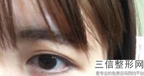 很薄的单眼皮适不适合割双眼皮，内双眼皮薄适合割什么样的双眼皮-