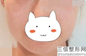 厚唇改薄诊断,嘴唇过厚的修饰方法