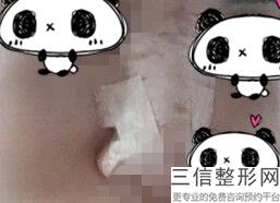 假体隆鼻手术有危险吗，假体隆鼻术后并发症