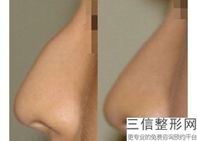 假体隆鼻手术有危险吗，假体隆鼻术后并发症