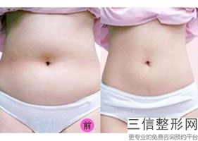 假体隆胸后怎样护理，假体隆胸恢复期要怎么按摩