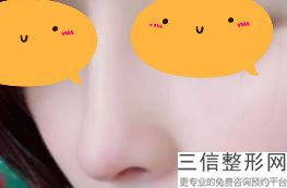 矫正鹰钩鼻需要多少钱，鹰钩鼻矫正方法不整容
