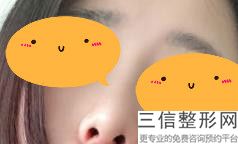 矫正鹰钩鼻需要多少钱，鹰钩鼻矫正方法不整容