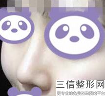 矫正鹰钩鼻需要多少钱，鹰钩鼻矫正方法不整容