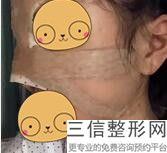 胶原蛋白和复合多肽隆鼻，胶原蛋白隆鼻怎么样