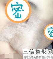 胶原蛋白隆鼻子，胶原蛋白隆鼻术