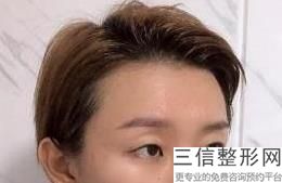 开眼角是不是一定会留疤,开眼角会不会留疤