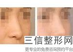 肋软骨隆鼻的危害有哪些，肋软骨隆鼻百度百科