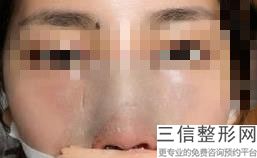 隆鼻玻尿酸多少钱一针，玻尿酸隆鼻子多少钱