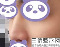 隆鼻手术修复是要重新做吗，隆鼻失败哪里可以修复