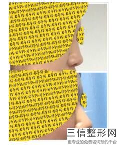 隆鼻需要了解的问题，隆鼻常见问题