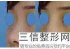 隆鼻子是打玻尿酸好还是做假体好，玻尿酸隆鼻和假体隆鼻哪个更自然