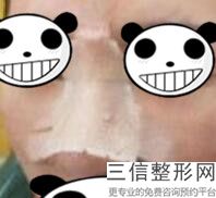 隆鼻子是打玻尿酸好还是做假体好，玻尿酸隆鼻和假体隆鼻哪个更自然