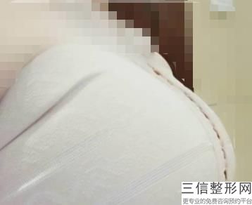 隆胸手术价格大概多少钱，隆胸手术一般多少钱啊