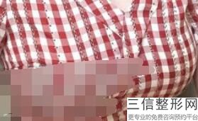 隆胸比较安全比较有效比较快的方式，哪种隆胸方式安全性高