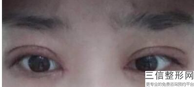 埋线双眼皮可以拆了重新埋线吗，埋线双眼皮不想拆线重做行不行