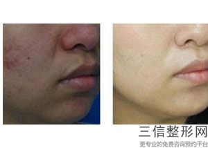 哪个三甲医院有热玛吉，三甲医院能做热玛吉吗