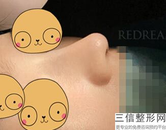 膨体隆鼻的优缺点，膨体隆鼻优势