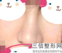 普通隆鼻和鼻综合的区别，综合隆鼻子