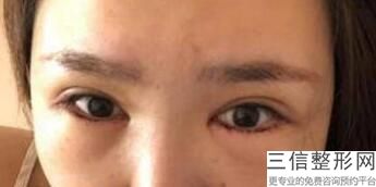 去眼袋比较有效的方法，去眼袋比较有效的方法百度百科