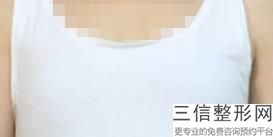 乳头缩小手术有危害吗，乳房缩小术有生命危险吗