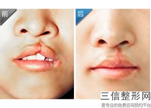深圳唇部整形哪里好,深圳哪家丰唇比较好