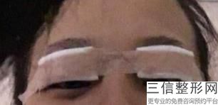 什么叫精雕双眼皮，精雕双眼皮怎么做