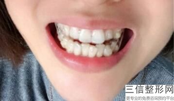 什么叫整牙，整牙有哪些